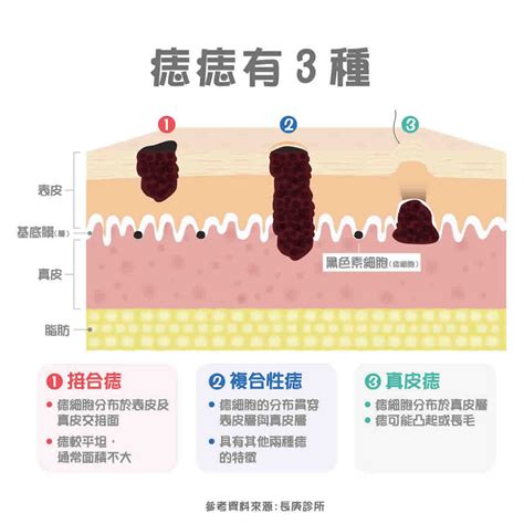 臉部痣|痣變大、痣多或長毛會變皮膚癌？認識痣的形成與原因